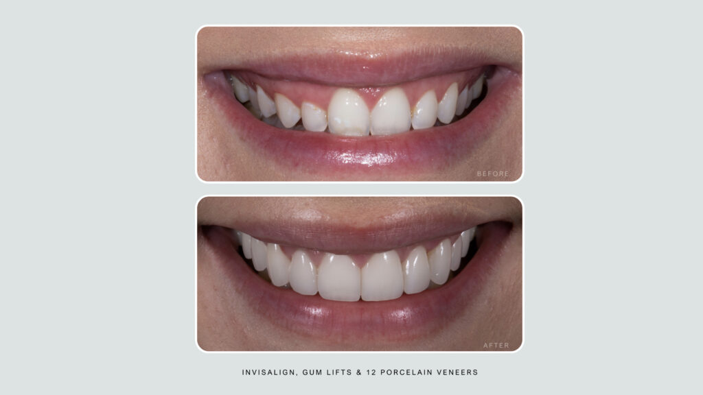 porcelain veneers