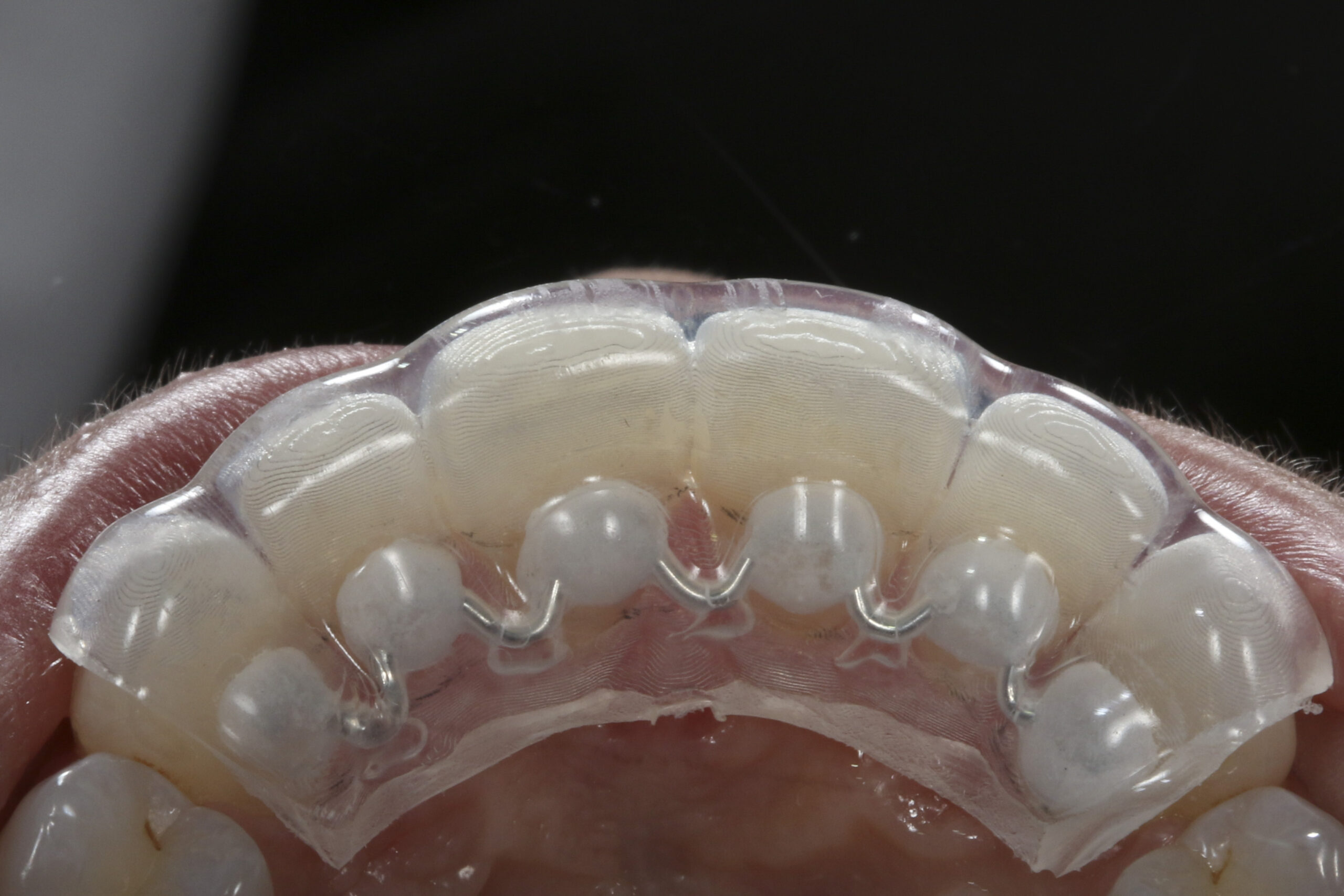 application of fixed retainer