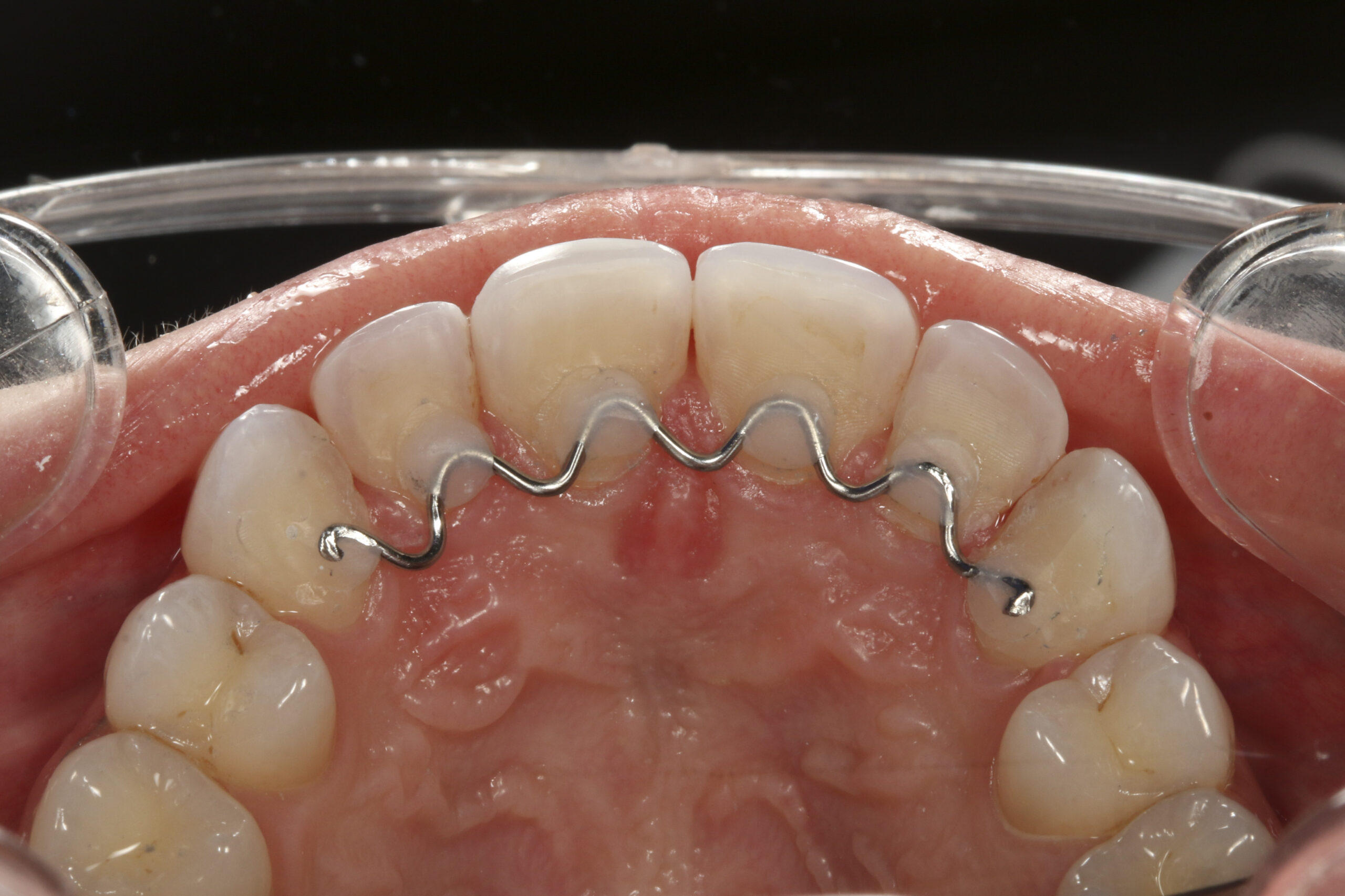 hygienic retainer on back of teeth