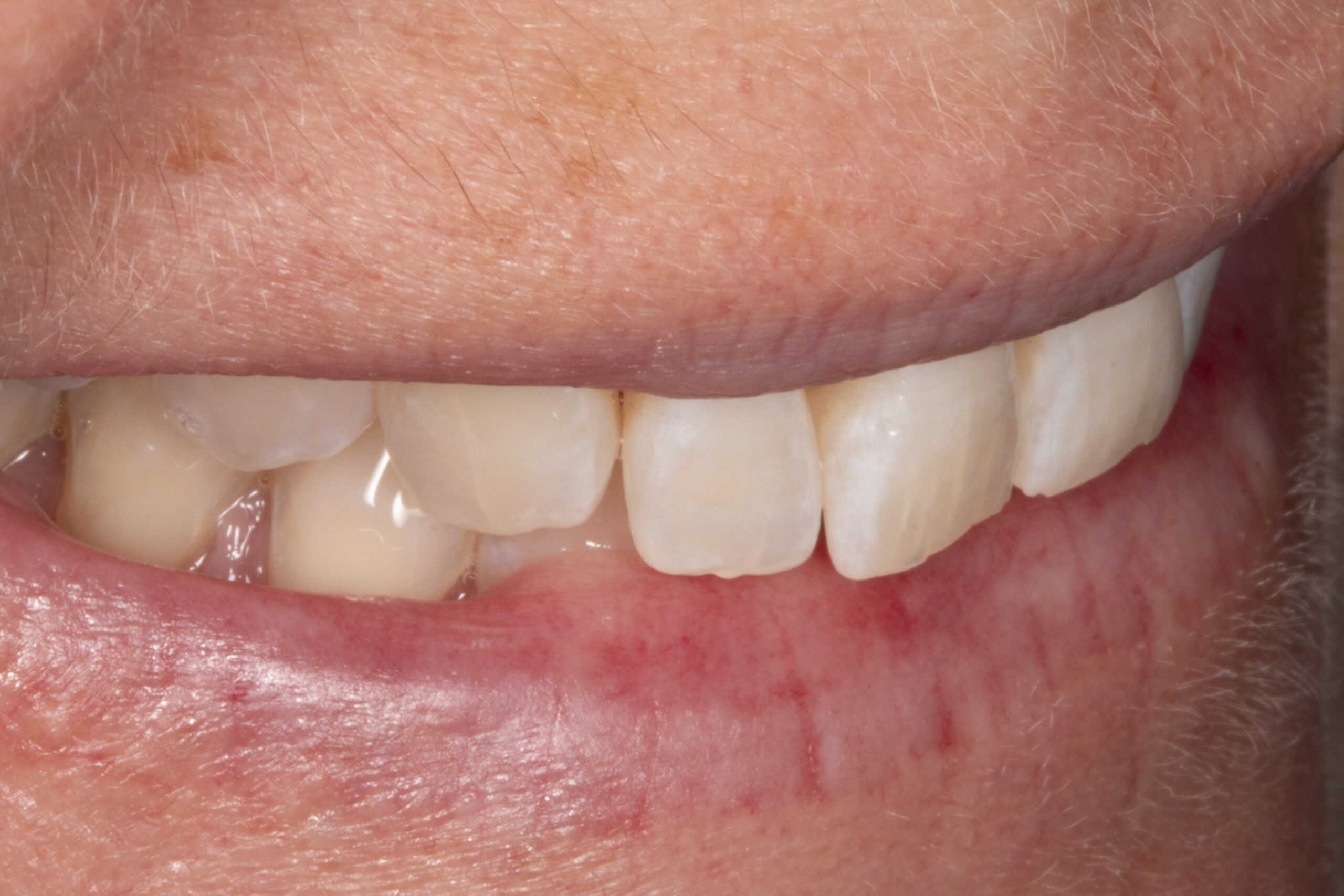 Pre-operative teeth before veneer treatment
