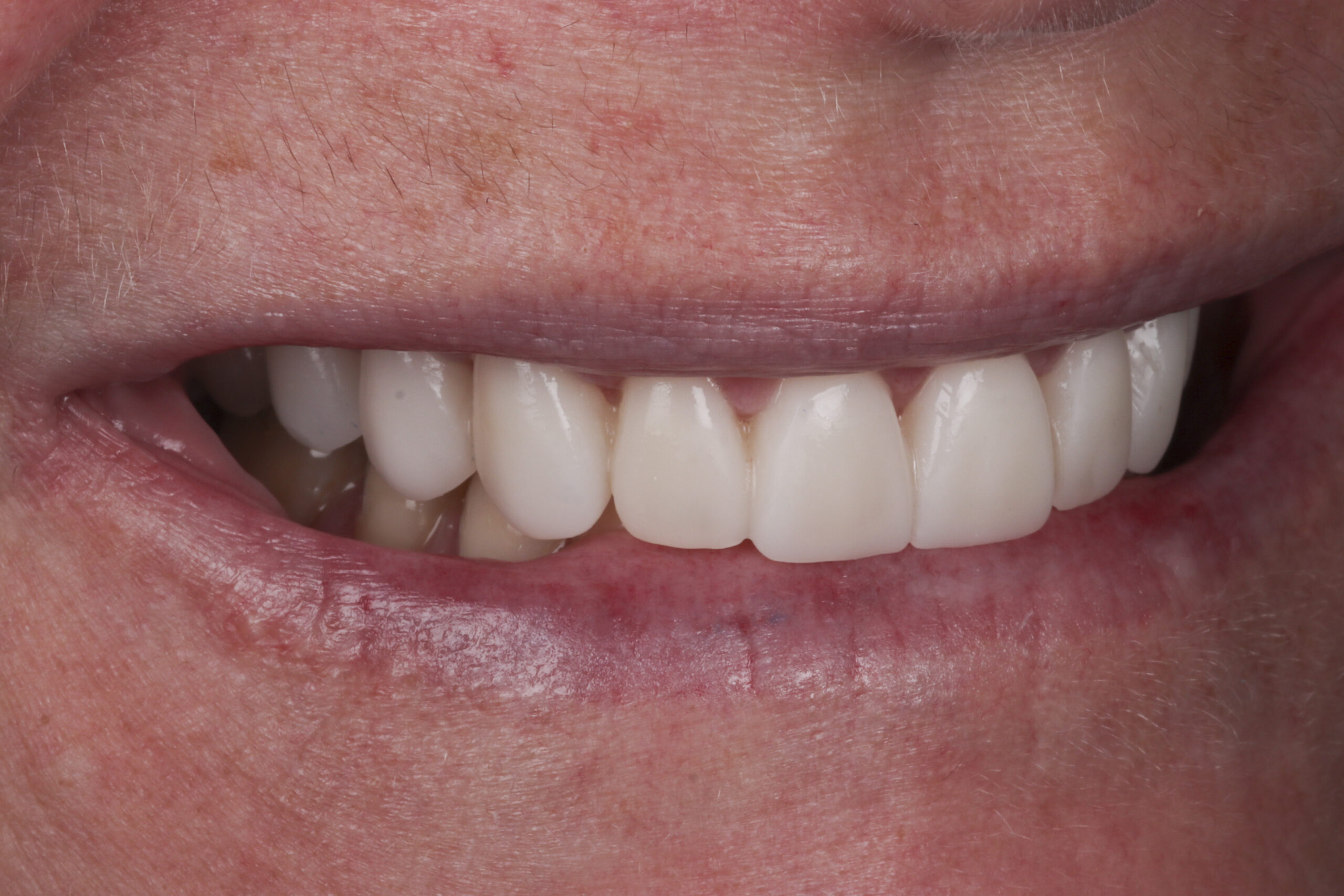 Temporary veneers used as a trial run before final porcelain veneers