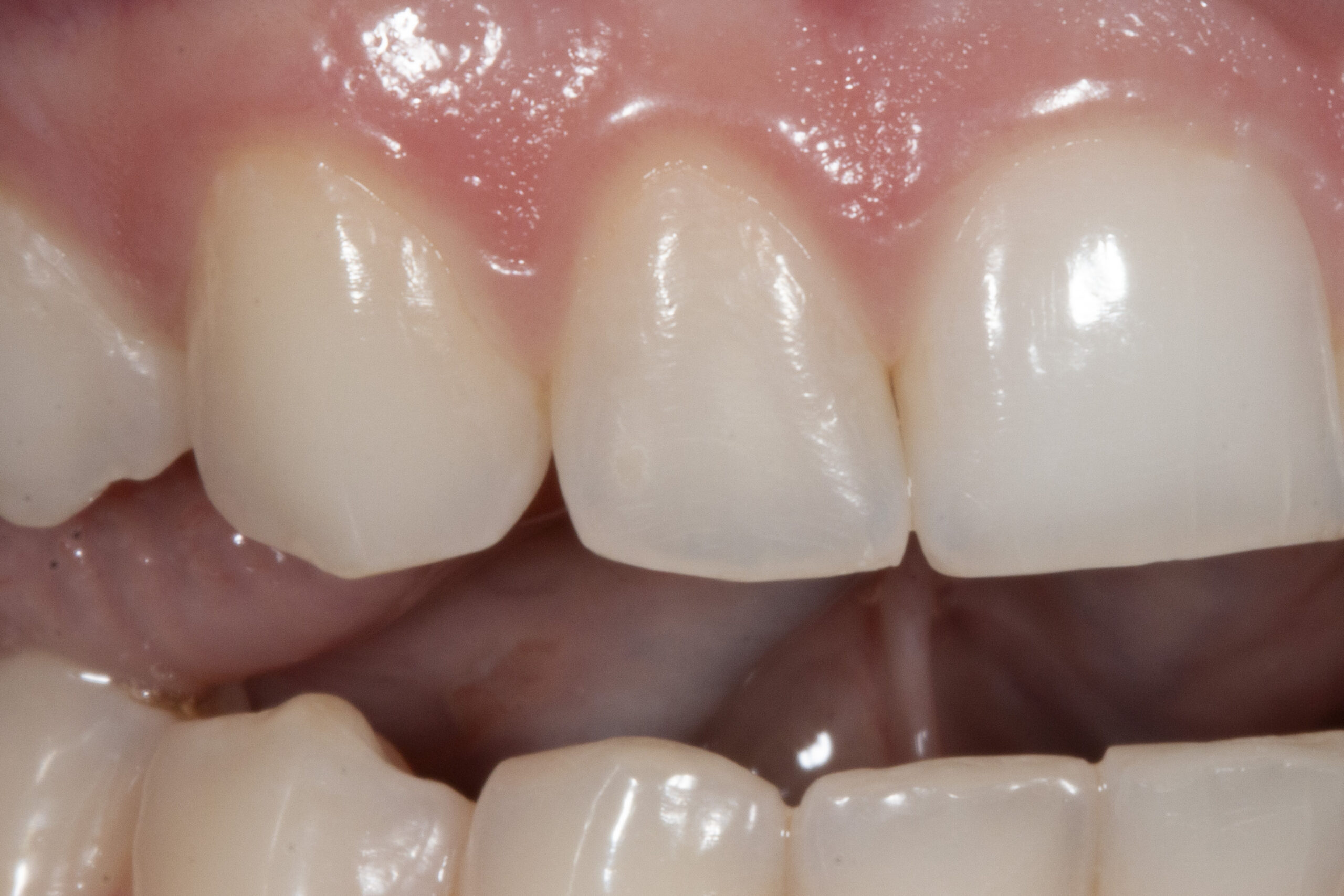 Pre-operative teeth before veneer preparation, natural teeth before cosmetic dentistry treatment