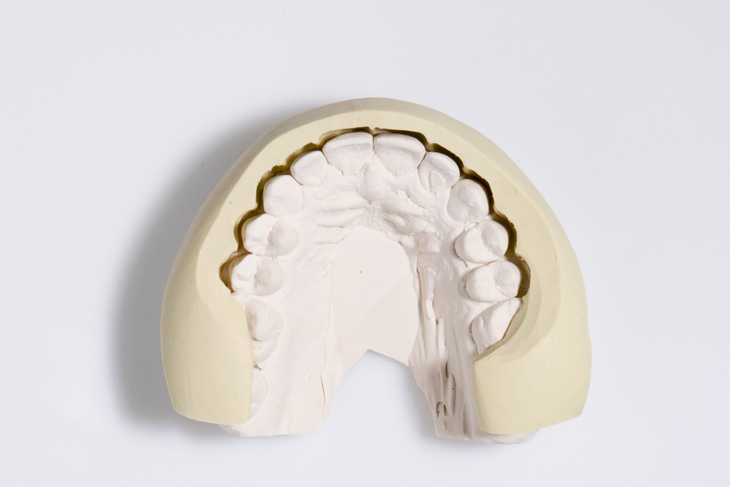 Will my teeth be shaved down for veneers?