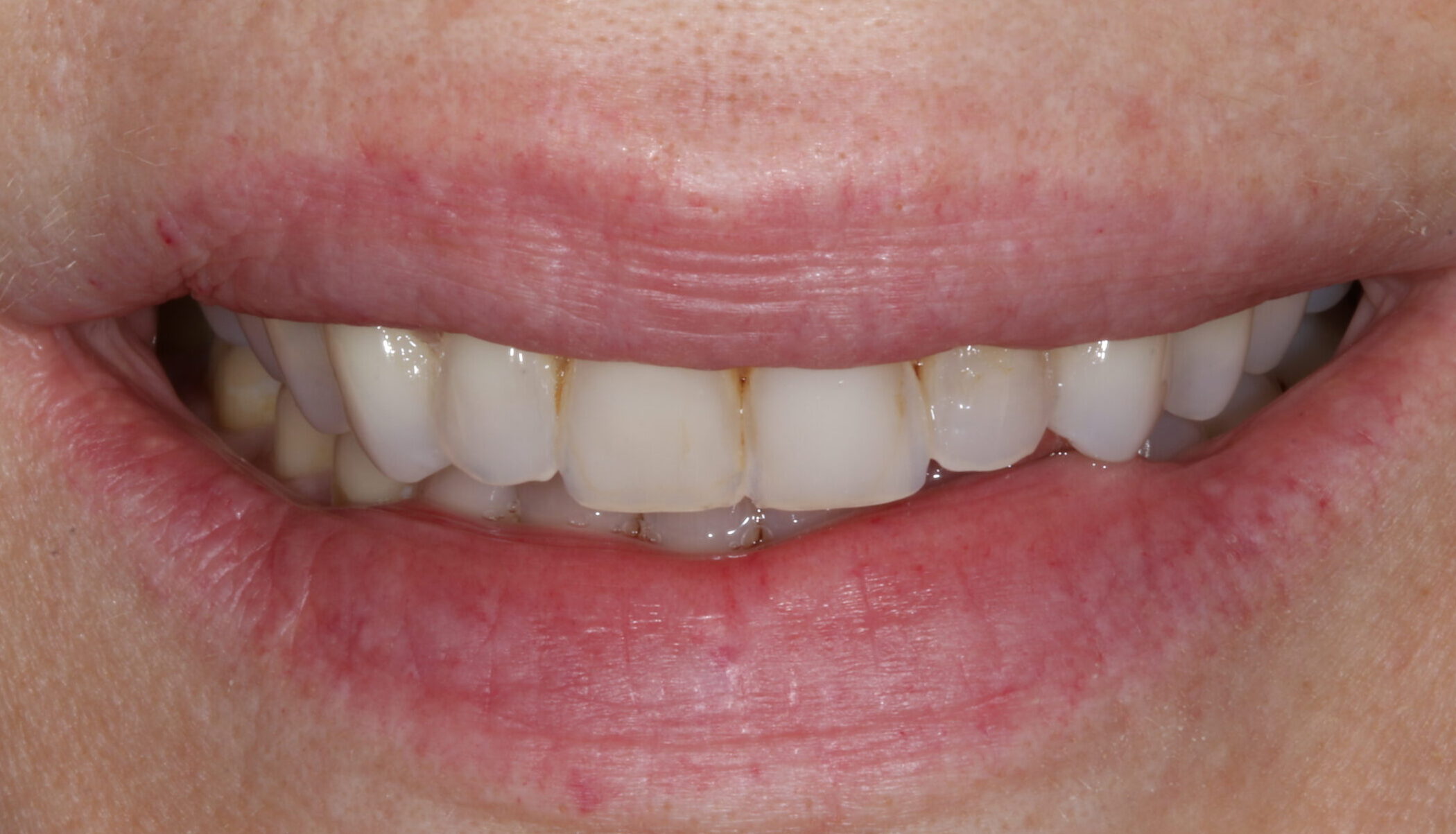 Initial presentation before temporary veneers, pre-operative teeth