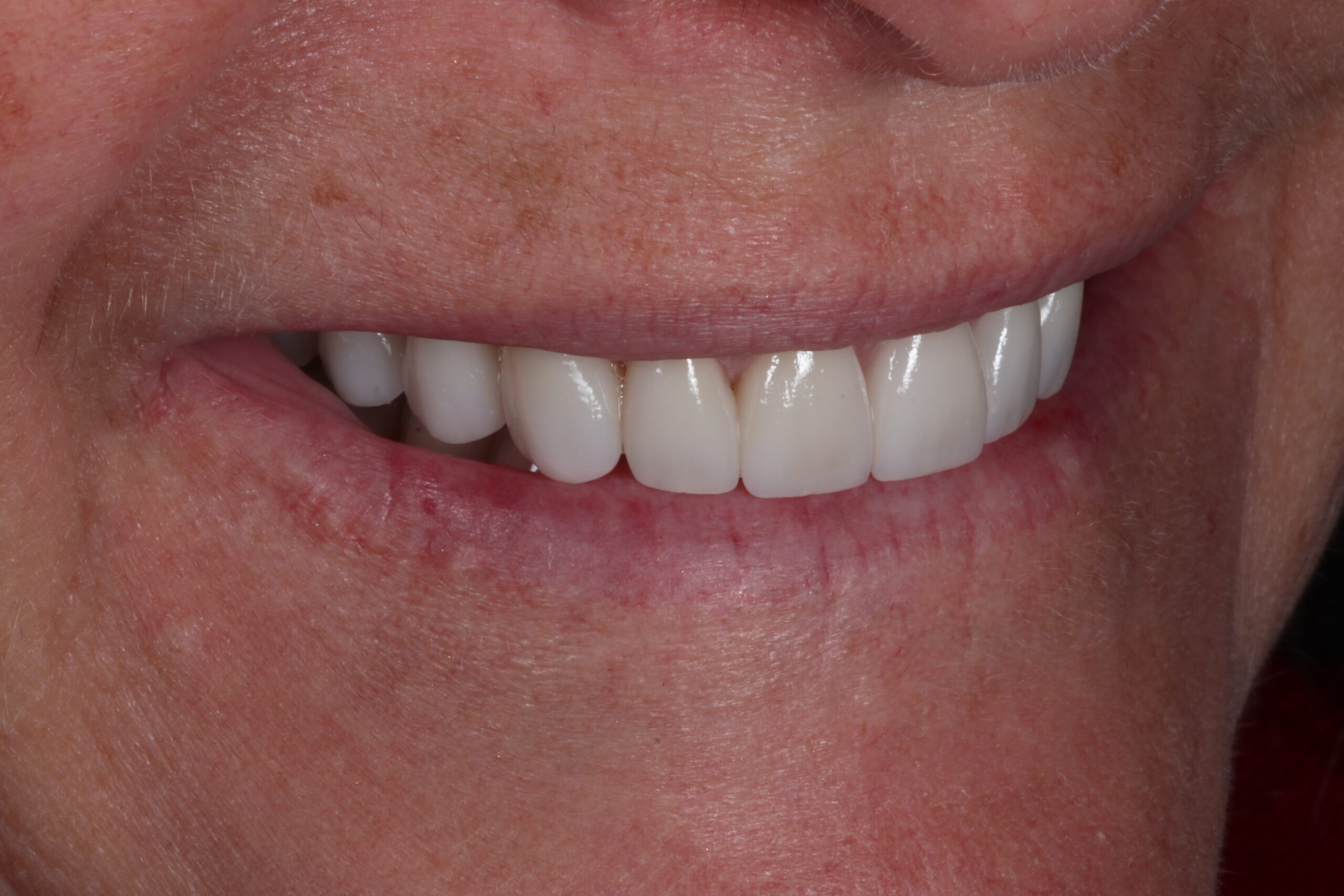 Final porcelain veneers reflecting light naturally like real teeth