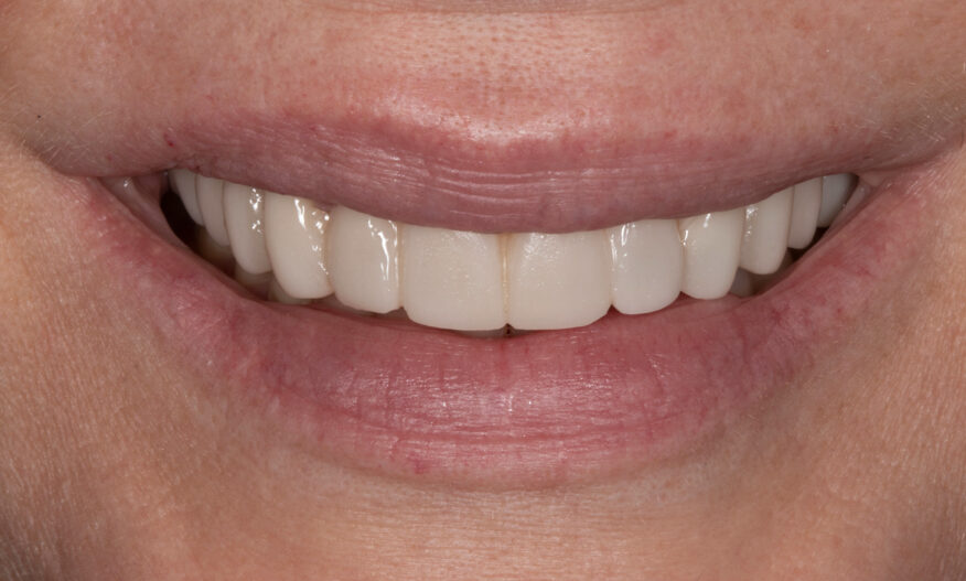Temporary veneers on top teeth in shade B1