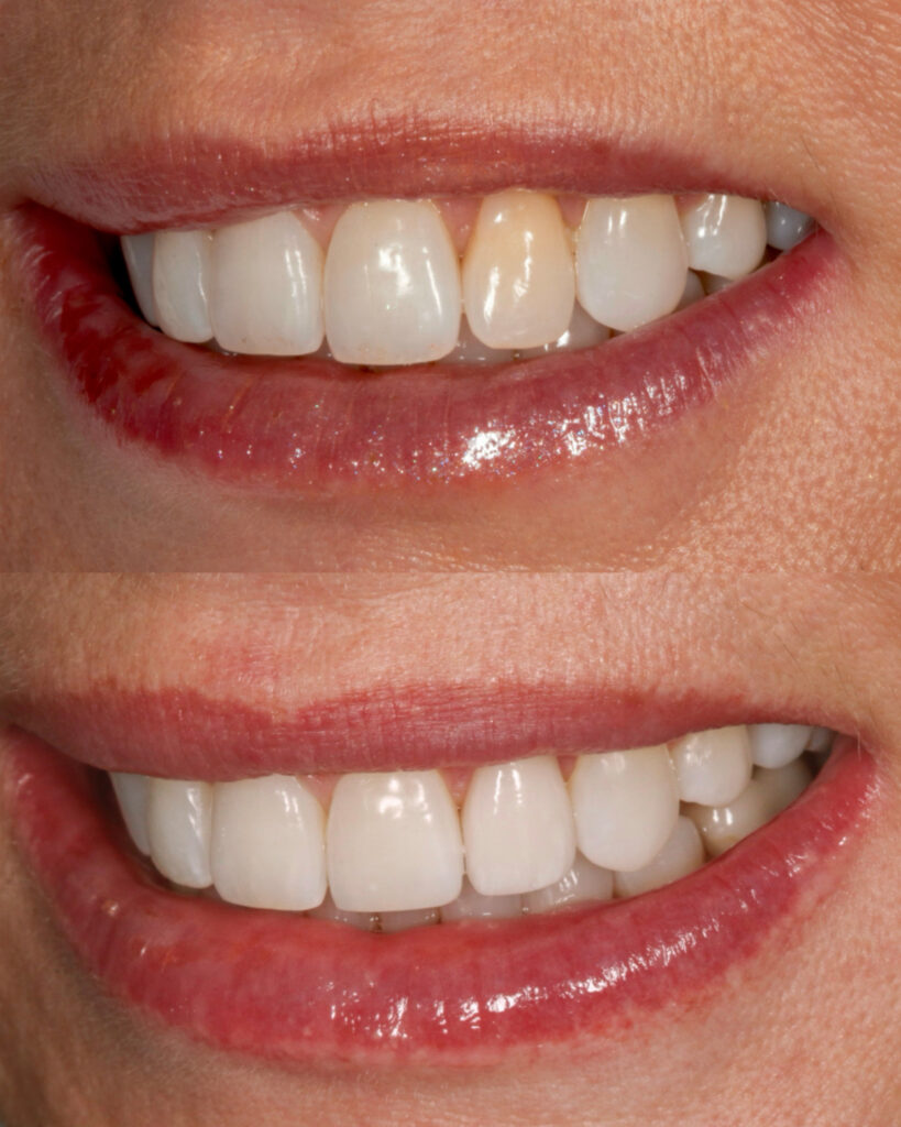 Before and after smile photos showing correction of a discolored lateral incisor with Invisalign and one porcelain veneer.