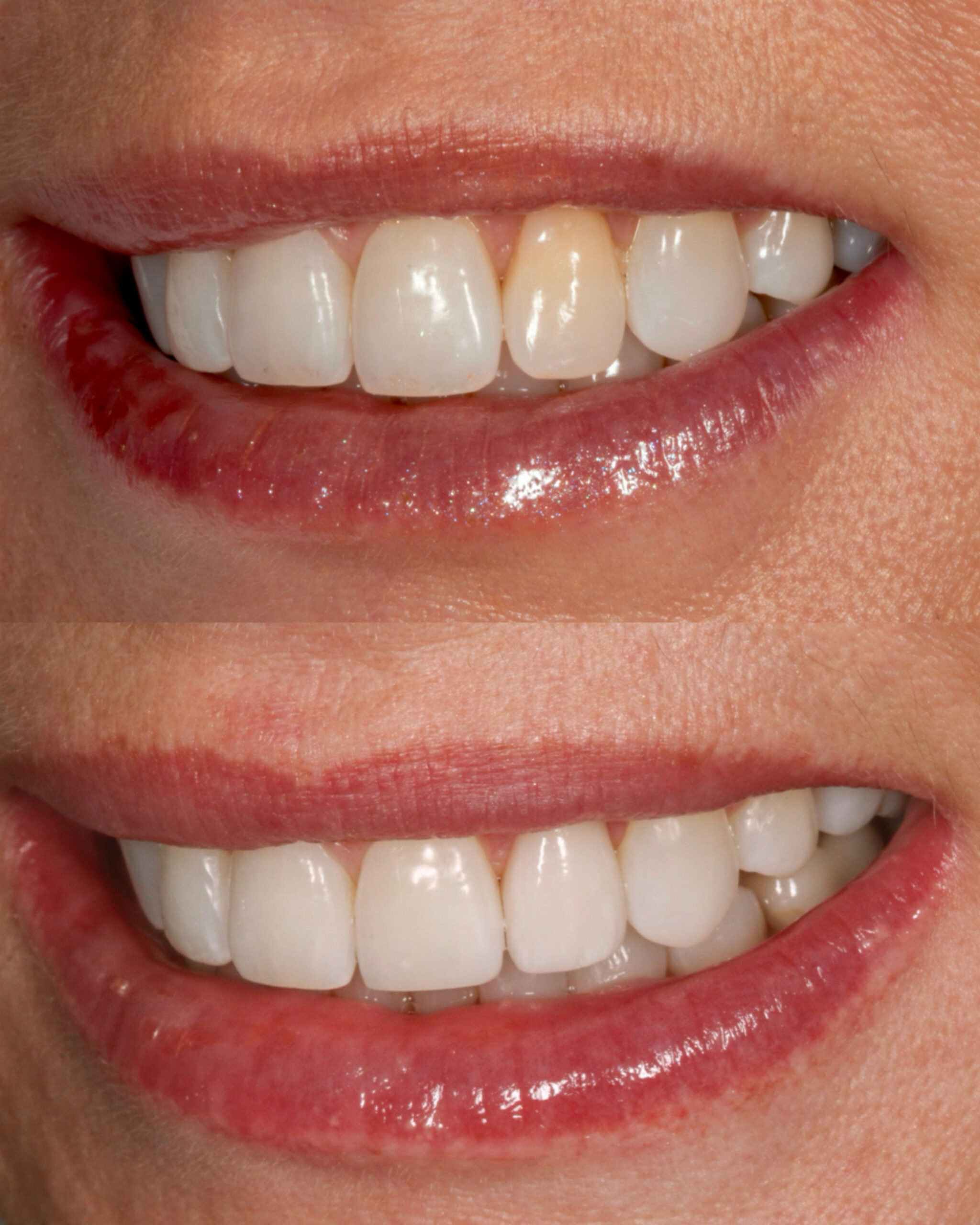 Before and after one porcelain veneer combined with Invisalign and Botox