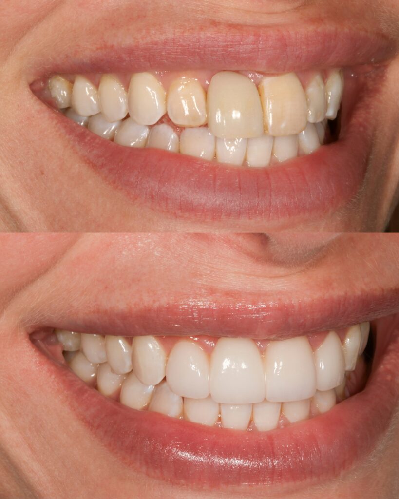 Before and after smile restoration at Charleston Dental Studio showing a new dental bridge, single porcelain veneer, and improved gingival symmetry.