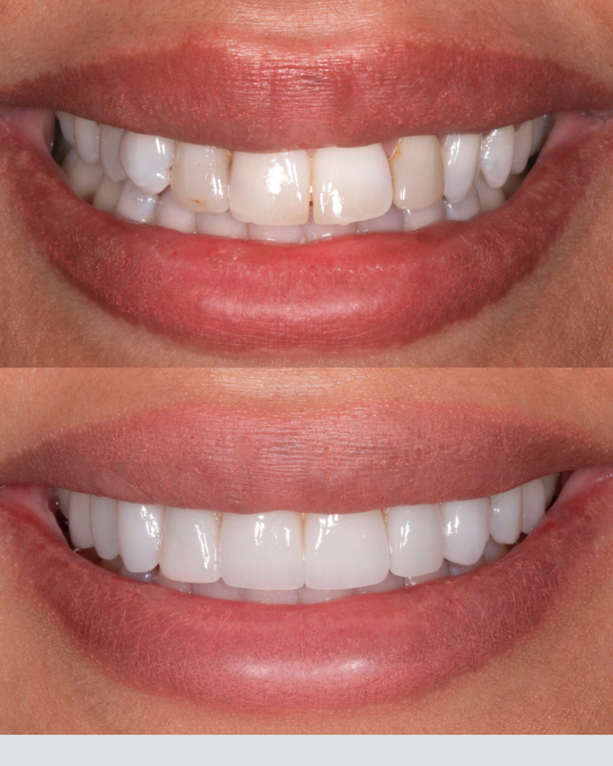 Before and after twelve porcelain veneers for a brighter broader camera-ready smile