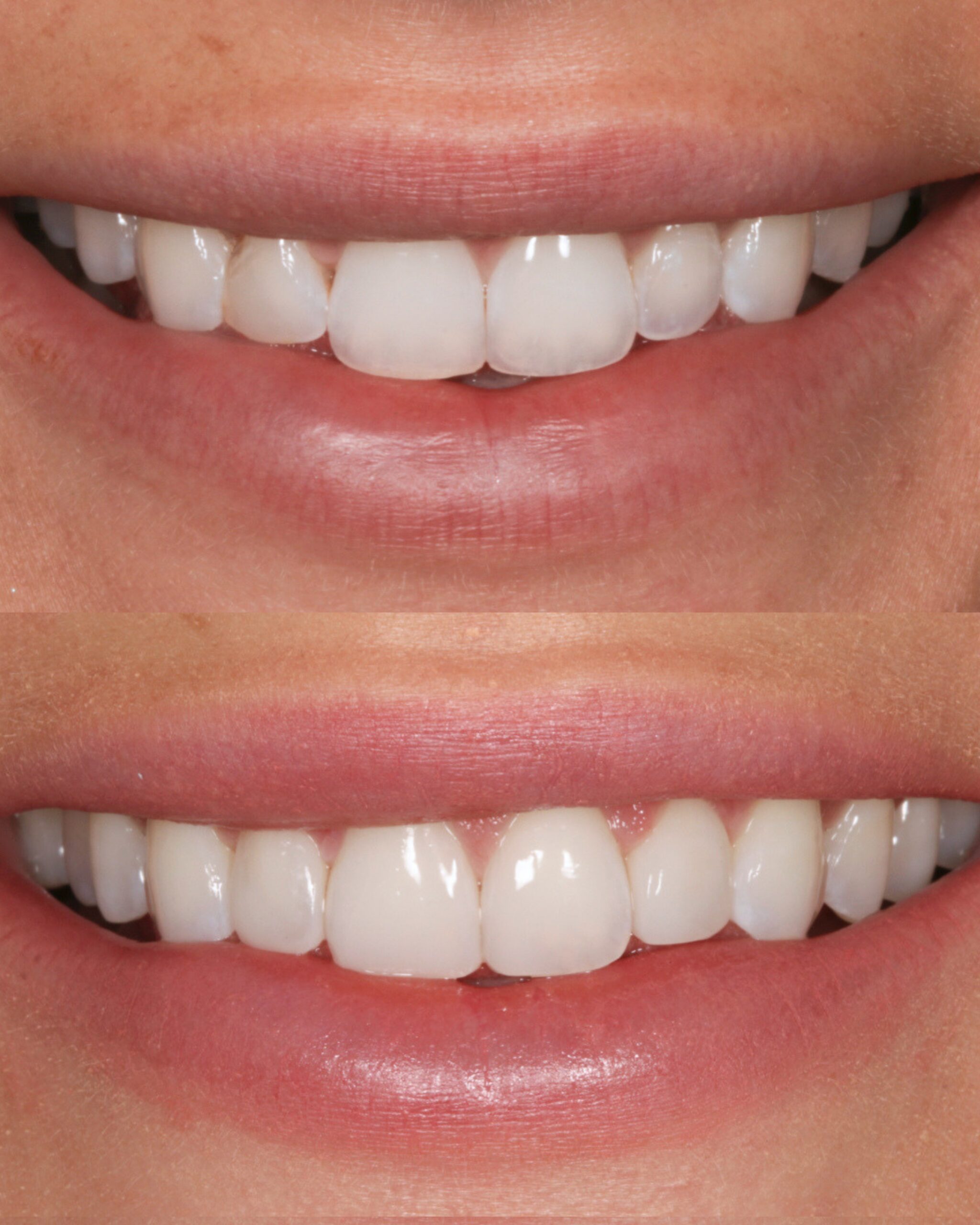 Before and after composite bonding on four upper front teeth at Charleston Dental Studio, correcting differences in tooth proportions while maintaining naturally rounded edges.