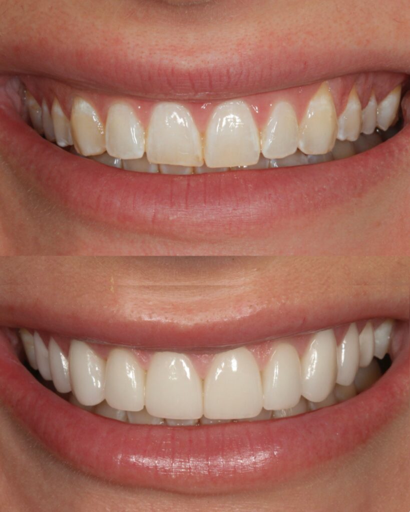 TEN FELDSPATHIC VENEERS — NATURAL SHADE Years of acidic and mechanical wear had left this patient's teeth discolored and uneven — but the underlying architecture of her smile was worth preserving. The goal was never to create something new, it was to rebuild and broaden what was already there, restoring the smile she had lost rather than replacing it with one she never had. Feldspathic porcelain was the only material that could achieve this. A natural B1 shade requires optical depth and layered translucency that pressed ceramics cannot replicate — the hand-layered feldspathic veneers by Rego Smiles were built to interact with light the way her natural enamel once did, with surface texture, lobes, and characterization guided by the specific features of her teeth and face.