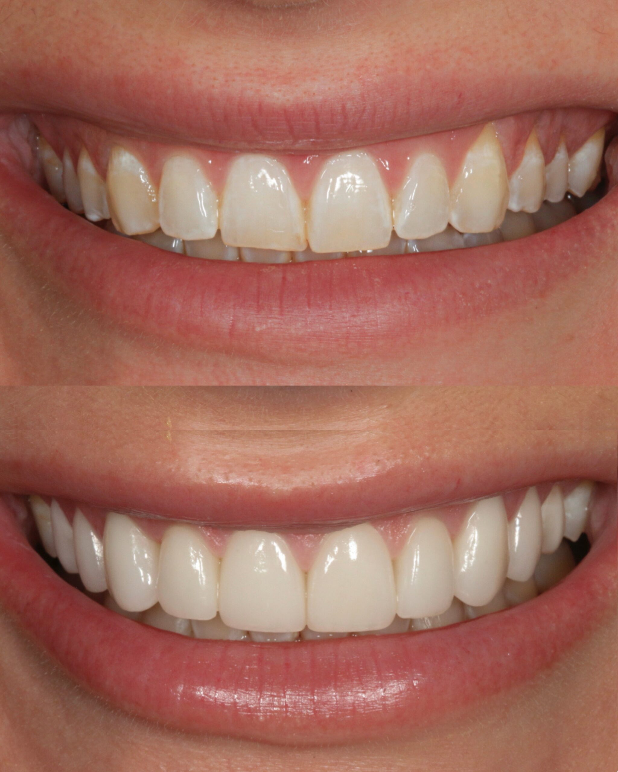 TEN FELDSPATHIC VENEERS — NATURAL SHADE Years of acidic and mechanical wear had left this patient's teeth discolored and uneven — but the underlying architecture of her smile was worth preserving. The goal was never to create something new, it was to rebuild and broaden what was already there, restoring the smile she had lost rather than replacing it with one she never had. Feldspathic porcelain was the only material that could achieve this. A natural B1 shade requires optical depth and layered translucency that pressed ceramics cannot replicate — the hand-layered feldspathic veneers by Rego Smiles were built to interact with light the way her natural enamel once did, with surface texture, lobes, and characterization guided by the specific features of her teeth and face.