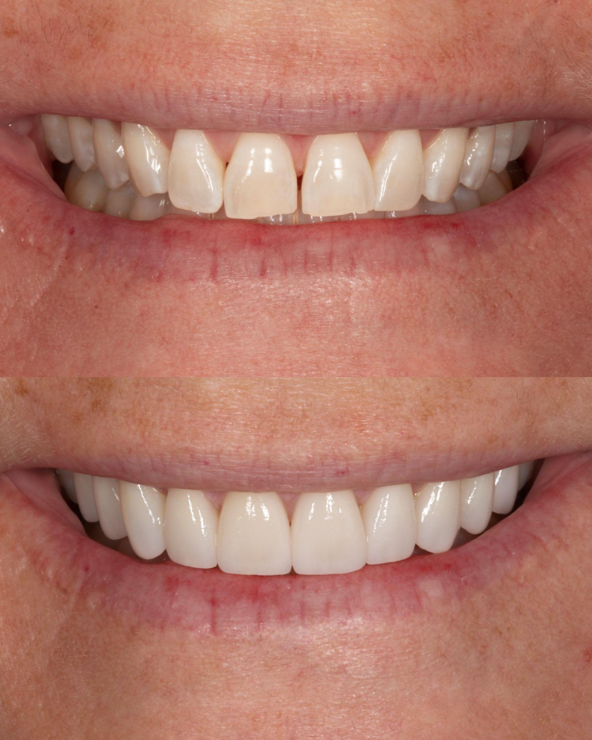 Before and after 10 porcelain veneers by Charleston Dental Studio
