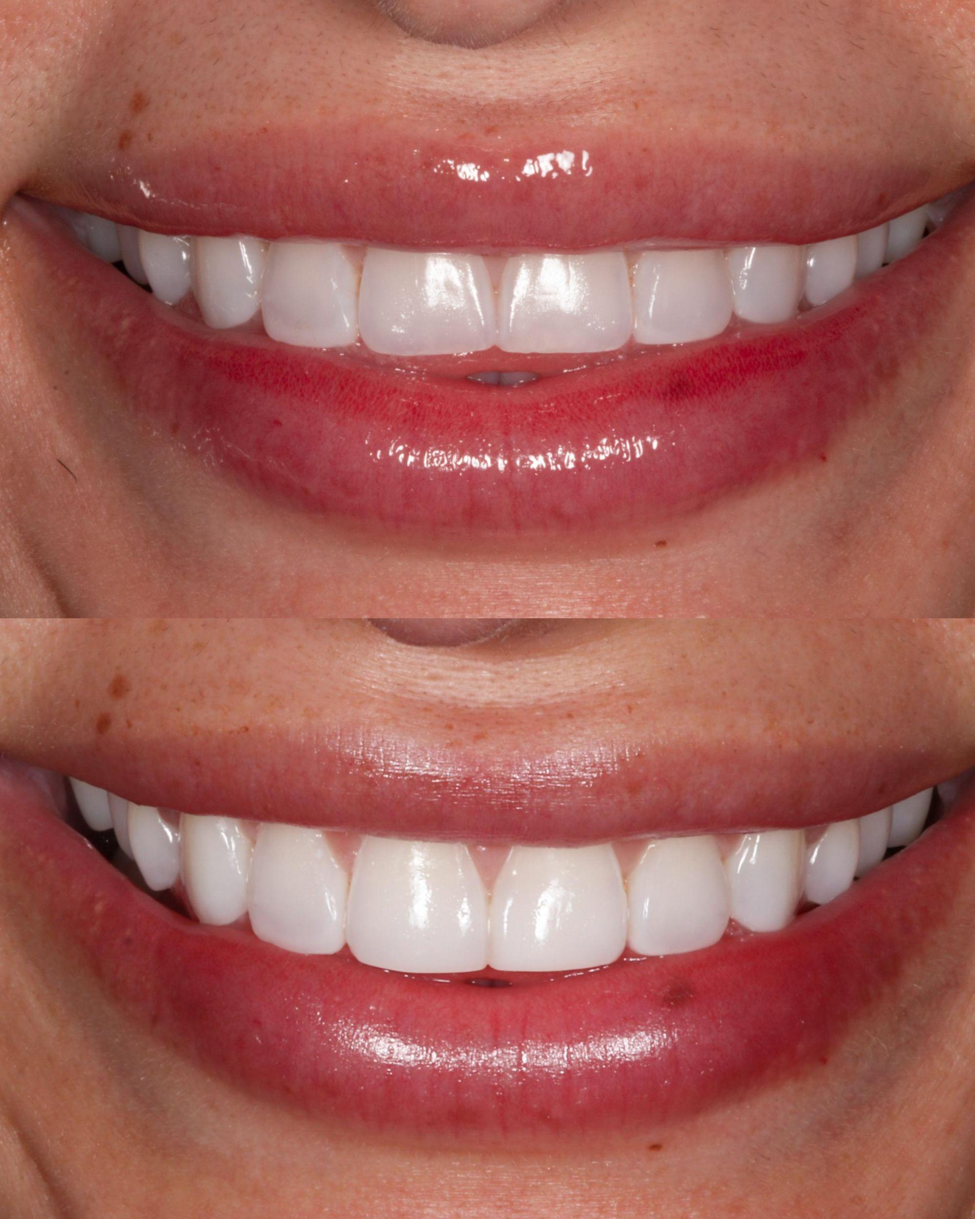 Before and after composite bonding to repair minor chipped and uneven front tooth edges at Charleston Dental Studio.